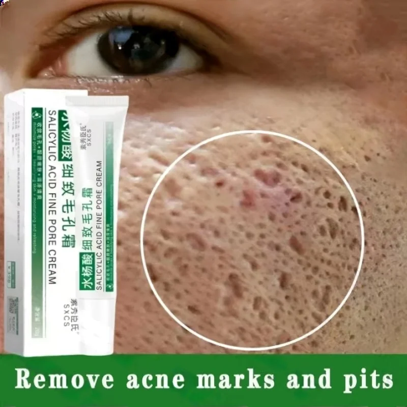 Crema per la pulizia dei pori  - Salicylic Acid Blackhead Remover recensione e prezzo